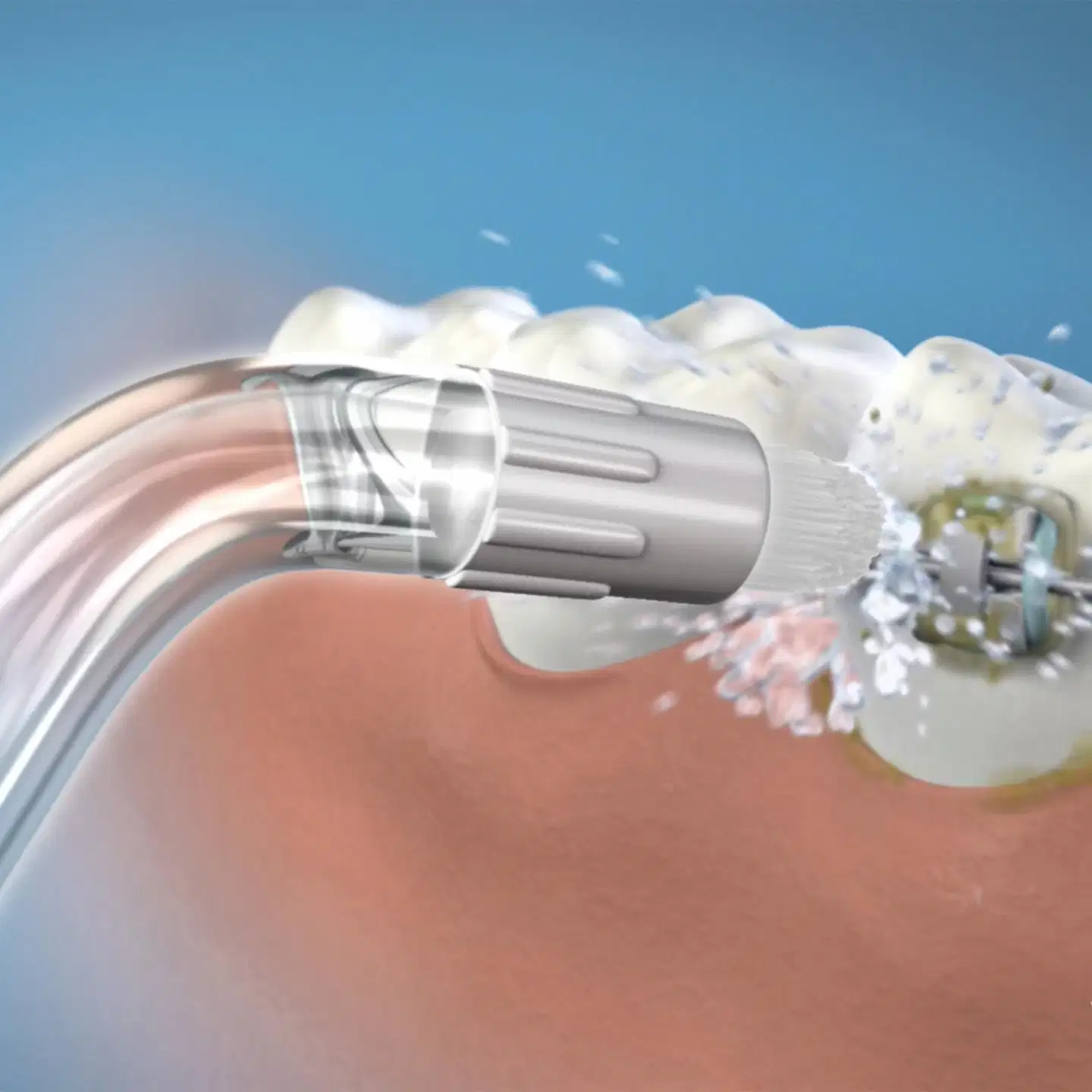 Waterpik OD-100E Orthodontic Tip oikomishoidon suuttimet 2 kpl - 3