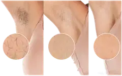 Philips Lumea IPL 8000 Series BRI946/00 karvanpoistolaite - 6